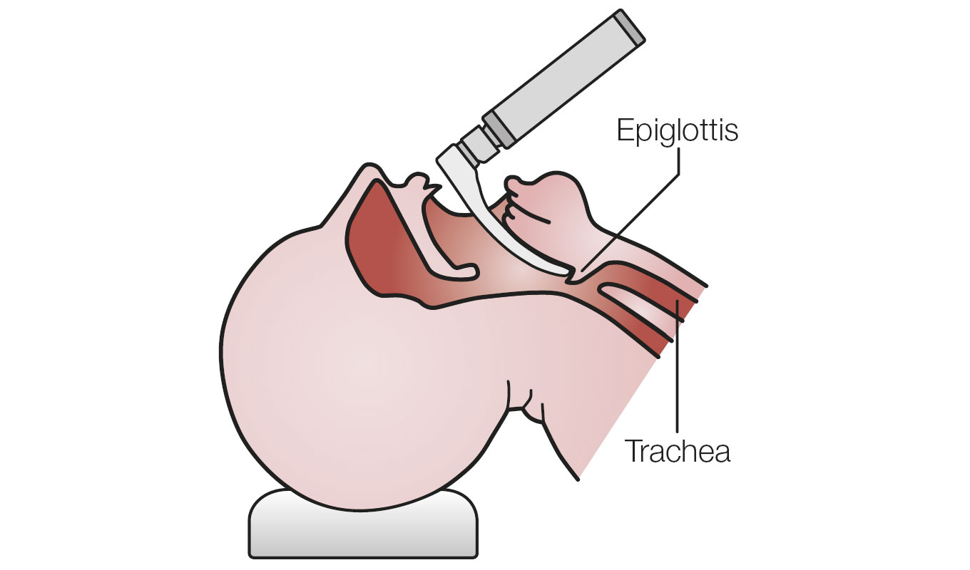 Intubation with HEINE Macintosh blade