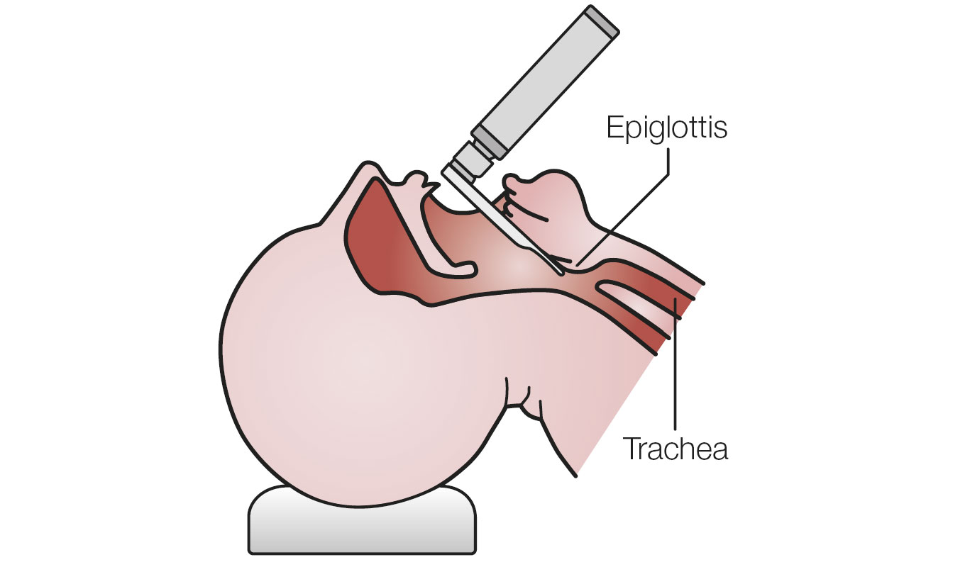 Intubation with HEINE Miller blade